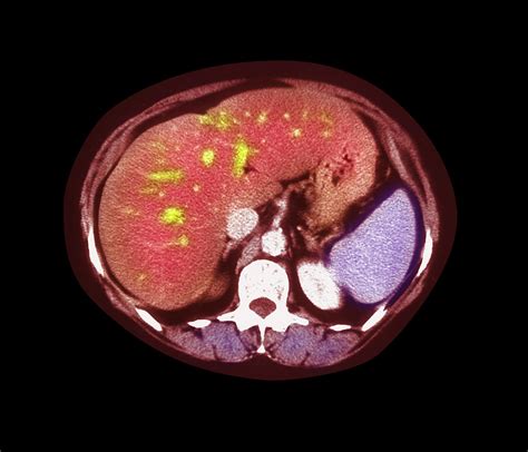 Fatty Liver Ct Scan Photograph by Simon Fraser/freeman Hospital, Newcastle Upon Tyne/science ...