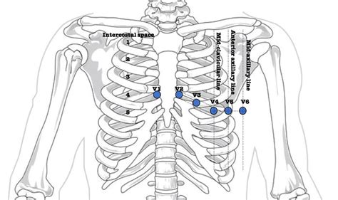 6: Precordial electrodes placement on the thorax to perform a standard ...