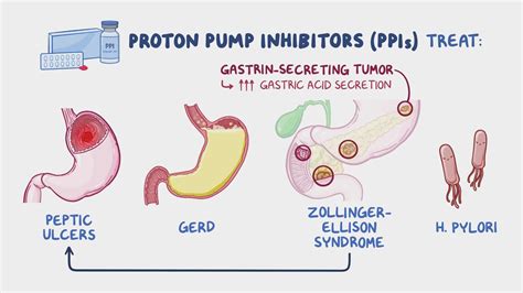 Proton pump inhibitors (PPIs): Nursing pharmacology - Osmosis Video Library