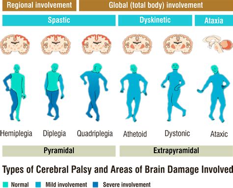 Cerebral Palsy Types / Major Types Of Cerebral Palsy By Life Way Issuu ...