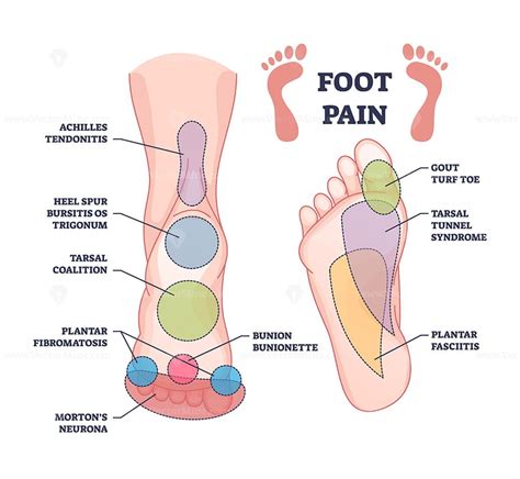 Foot Pain Causes From Zones Diagnosis And Painful Spots, 07/23/2023