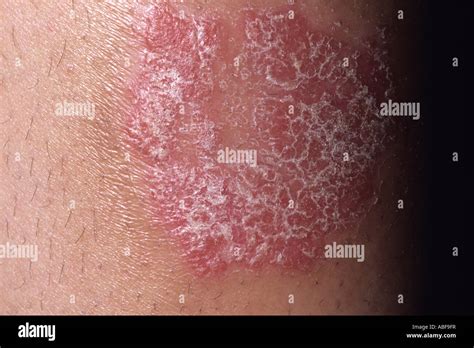 Erythematous skin plaque hi-res stock photography and images - Alamy