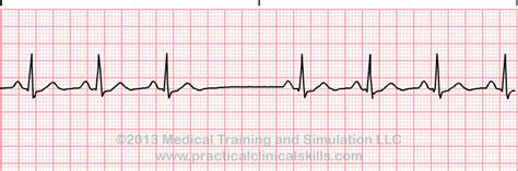 Sinoatrial Block EKG Interpretation with Rhythm Strip