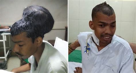 Doctors In India Remove The World's Largest Brain Tumor