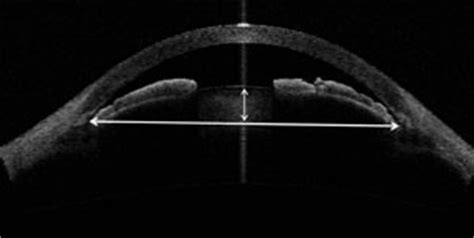 Managing Narrow Angles and Glaucoma