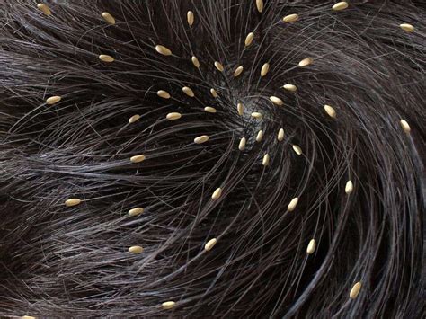 Head Lice: Head Lice Symptoms