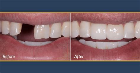 Dental Implants - Confident Smiles