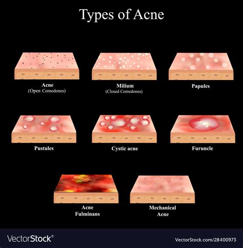 Types acne skin inflammation pimples boils Vector Image