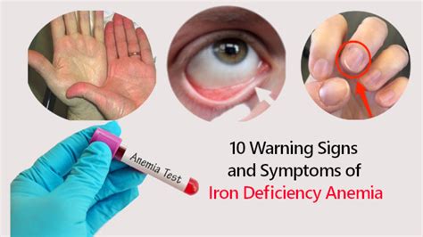 Symptoms Of Iron Deficiency Anemia