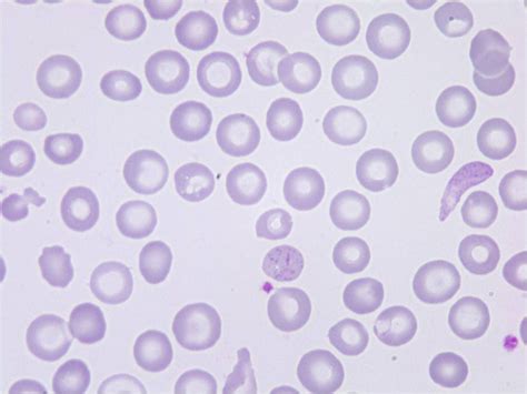 Saturnism: haemolytic anemia due to lead poisoning