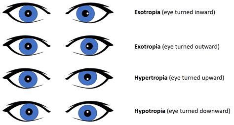 Corneal Light Reflex Abnormal Findings