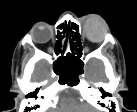 Ruptured globe | Radiology Case | Radiopaedia.org