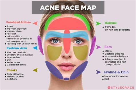 Acne Face Map: What Your Breakouts Are Trying To Tell You