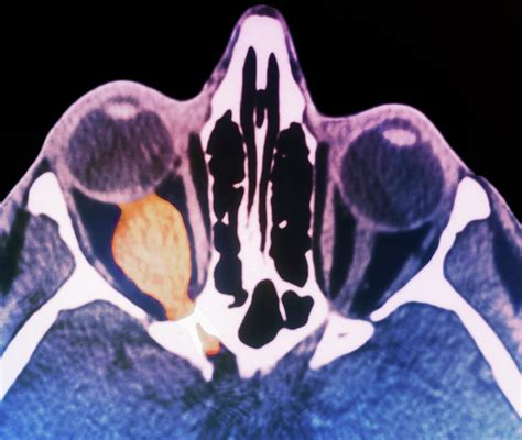 Optic Nerve Tumour Photograph by Science Photo Library - Pixels