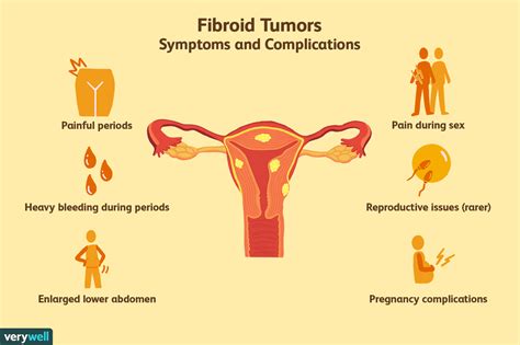 Uterine Fibroid Tumors: Symptoms, Causes, Diagnosis, and Treatment