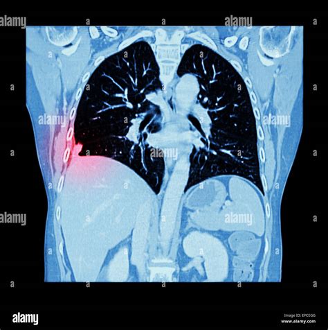 Lung cancer ( CT scan of chest and abdomen : show right lung cancer ...