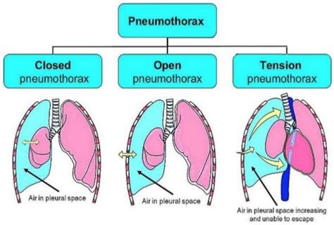 Tension pneumothorax,WHAT TO DO? | Nursing school survival, Respiratory ...