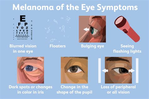 How to Prevent, Identify, and Treat Melanoma of the Eye