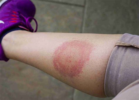 Lyme Disease from a Tick Bite: How do you know if you will get it?