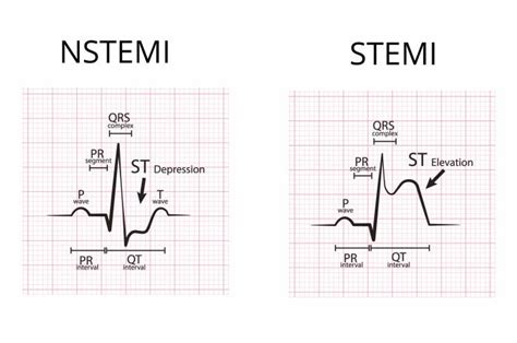 Was ist ein NSTEMI-Infarkt?