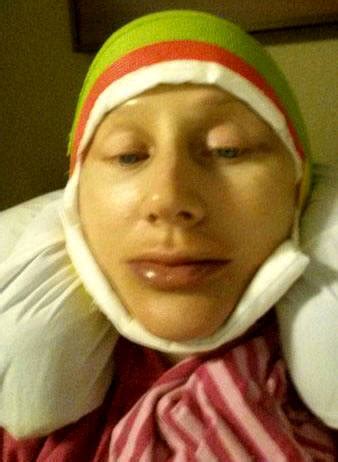 Smas Facelift Recovery Photo (4) » Facelift: Info, Prices, Photos, Reviews, Q&A