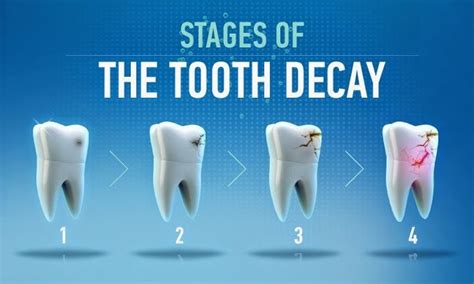 Tooth Decay Stages | Dental Dentist