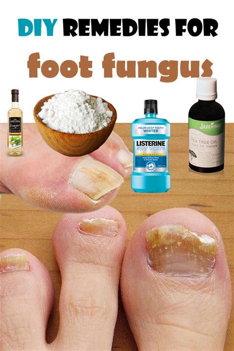 DIY remedies for foot fungus | Top Health Remedies