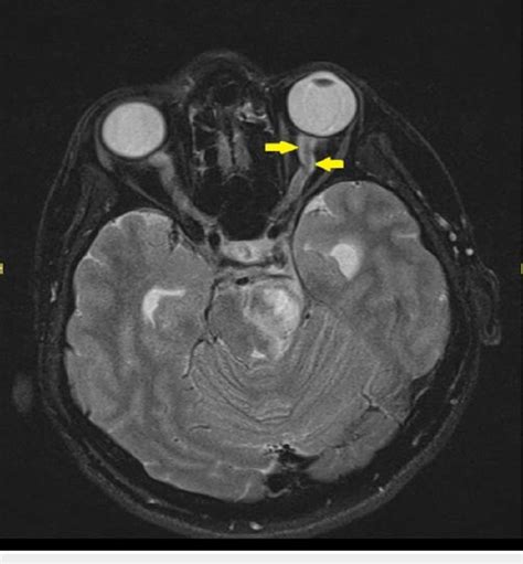 Magnetic resonance imaging (MRI) showed kinked left optic nerve with... | Download Scientific ...