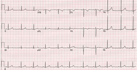 The Normal ECG