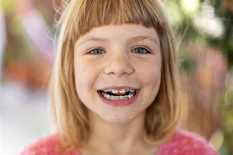 Benefits of Braces for Kids | Pediatric Dentistry Services TX