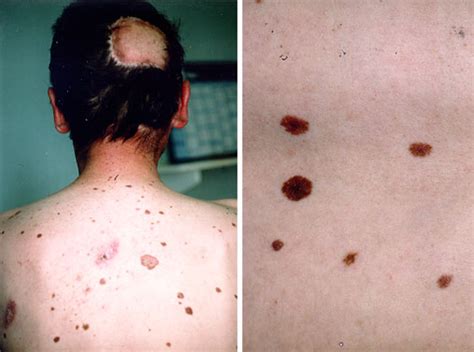 Dysplastic nevus syndrome (DNS)