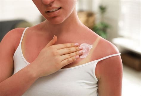 What Are The Signs And Symptoms Of Sun Poisoning? | The Well by Northwell