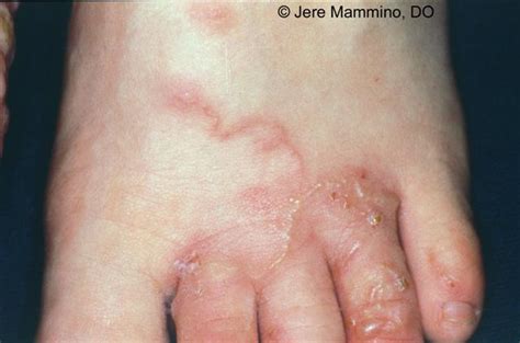 Cutaneous Larva Migrans - American Osteopathic College of Dermatology (AOCD)