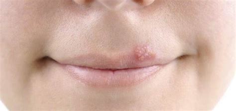 Pimple on Lip: 10 Causes and Natural Remedies | Daily Health Cures