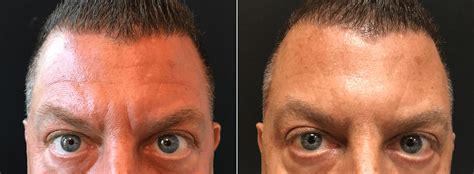 Male Botox for Forehead Lines and Frown Lines Before & After Photos New Jersey - Reflections Center