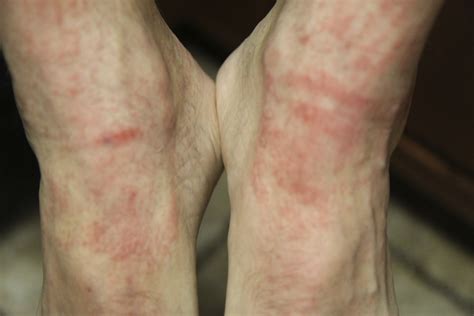 What causes a rash on my feet