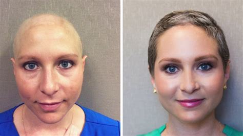 Chemo Hair Loss Eyebrows : Chemo Patient Says Eyebrow Gel Helped Her Keep Brows And Lashes ...