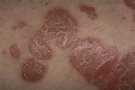 Psoriasis skin rash pictures | Symptoms and pictures