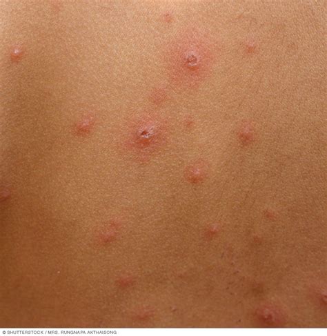 Lessons I Learned From Info About How To Prevent Or Control Chicken Pox ...