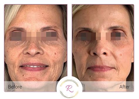 ClearLift Skin Resurfacing - Revitalized Aesthetics and Beauty Bar