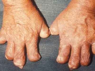 What Is Leprosy;Diagnosis,Treatment,Prevention - Notes Read