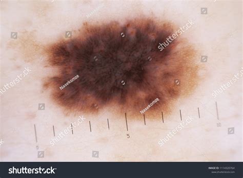 Dysplastic Nevus: Over 31 Royalty-Free Licensable Stock Photos ...