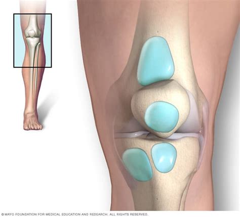 Lateral Bursitis Knee