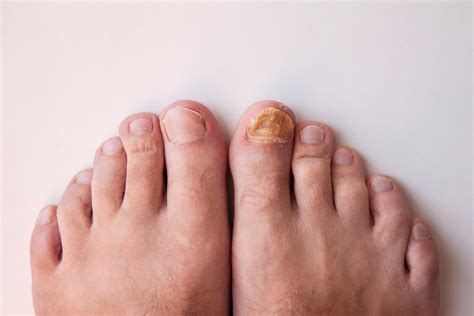 What Causes Toenail Fungus & How Can It Be Treated? | Arizona Foot Doctors