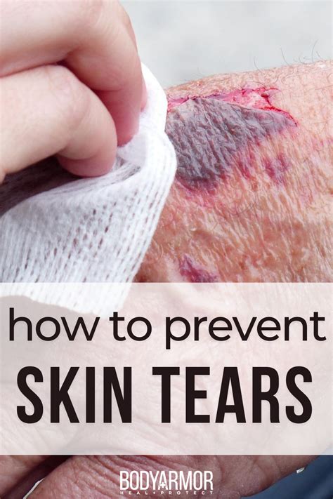 10 Steps for Skin Tear Prevention | BODYARMOR MEDICAL SUPPLIES | Home ...