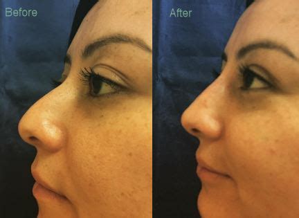 Hyaluronic Acid Fillers - Petaluma Aesthetics