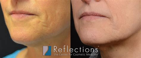 RF Microneedling for Fine Lines & Wrinkles Around the Mouth Before & After Photos New Jersey ...