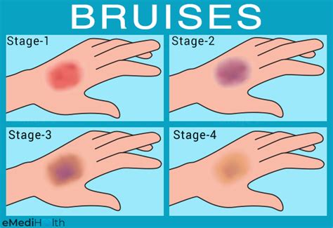 Possible Reasons and Risk Factors for Bruises - eMediHealth