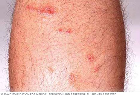 Poison ivy rash - Symptoms and causes (2023)