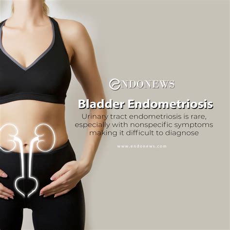 Bladder Endometriosis | EndoNews